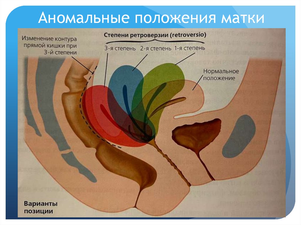 Аномальные положения матки