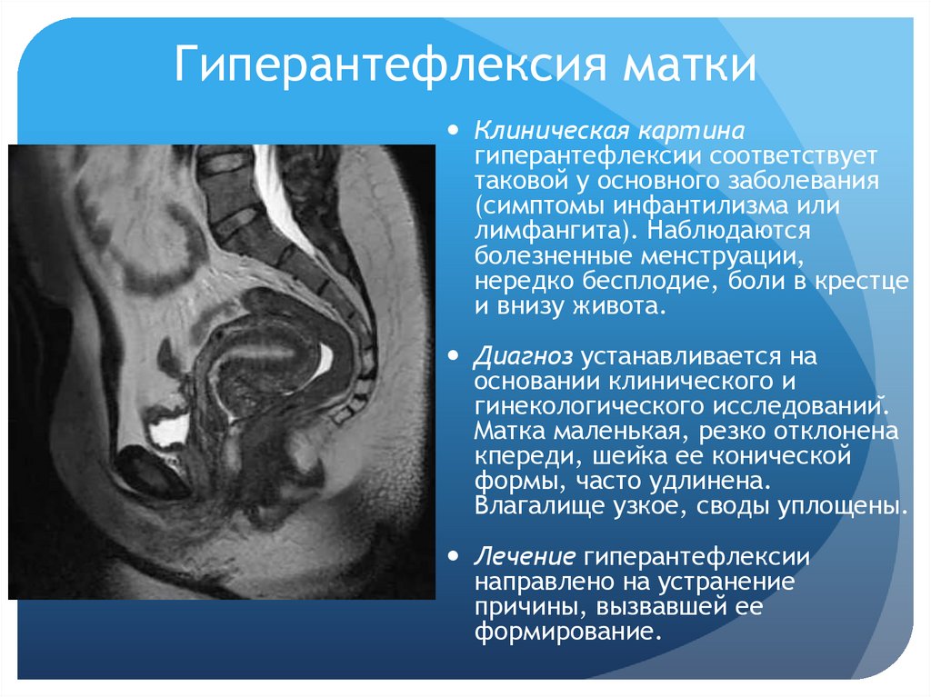 Гиперантефлексия матки