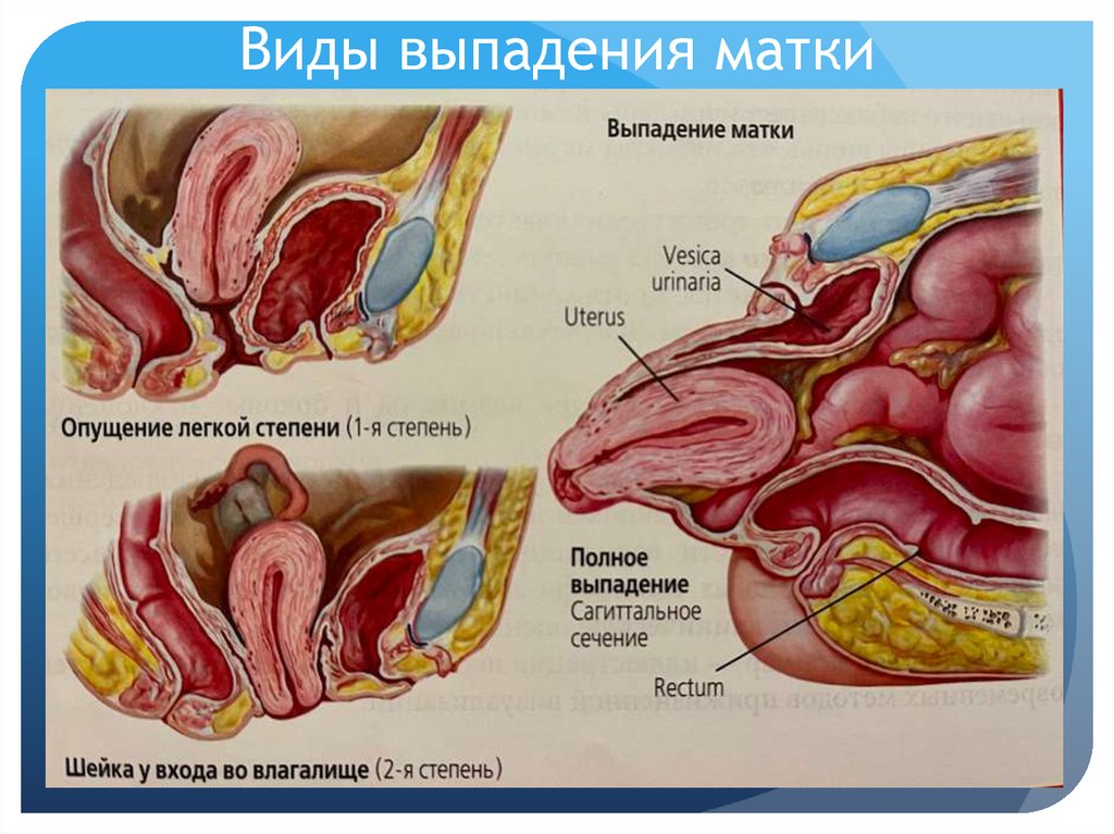 Виды выпадения матки