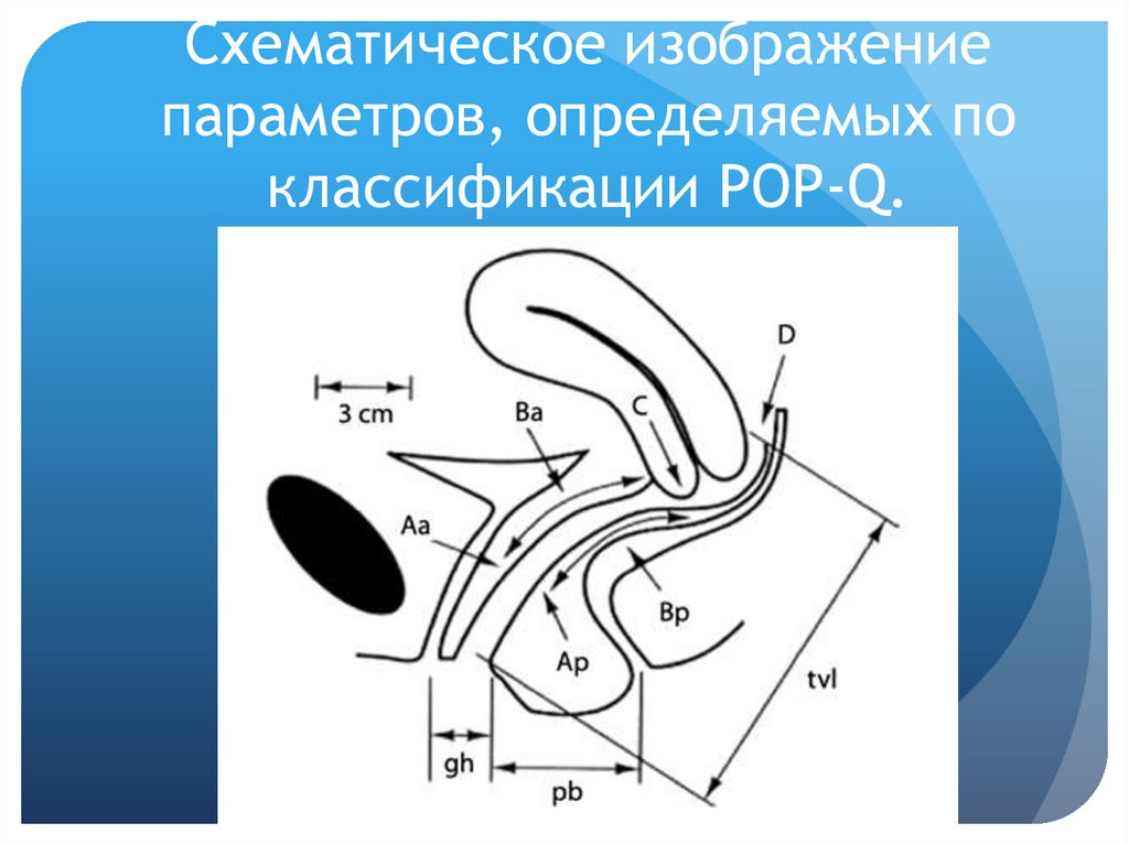 Схематическое изображение параметров, определяемых по классификации POP-Q.