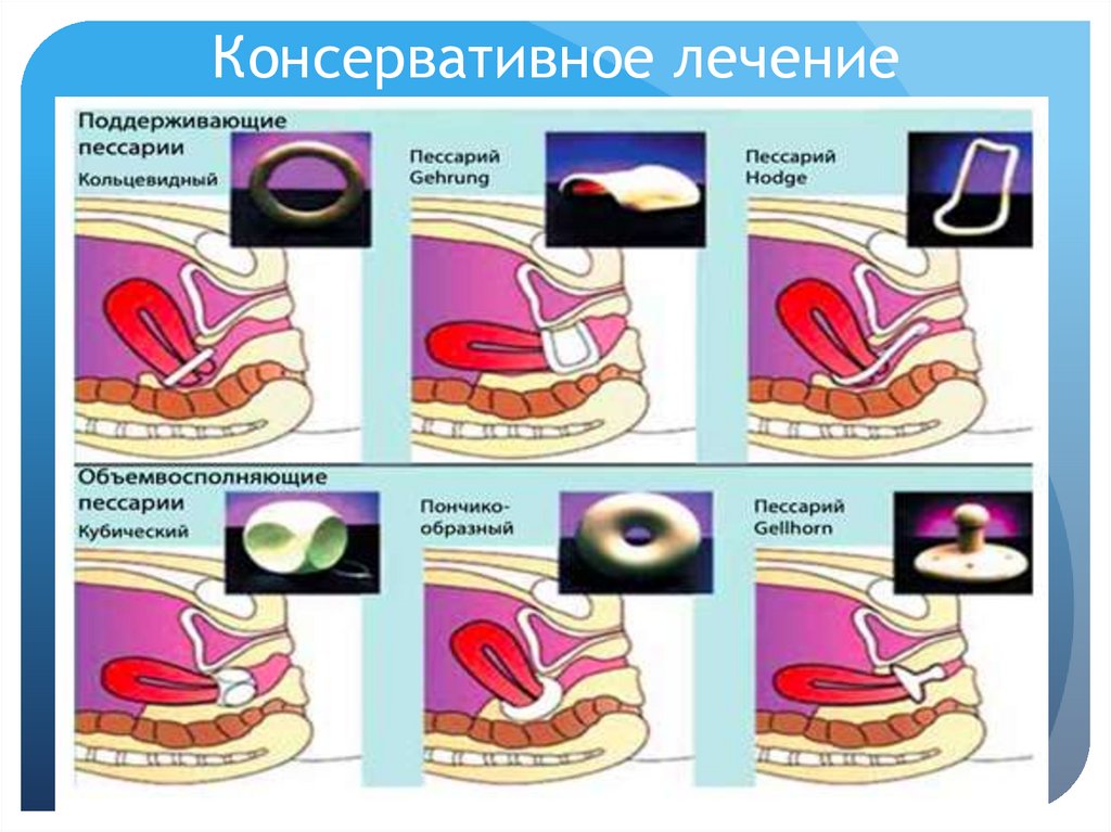 Консервативное лечение