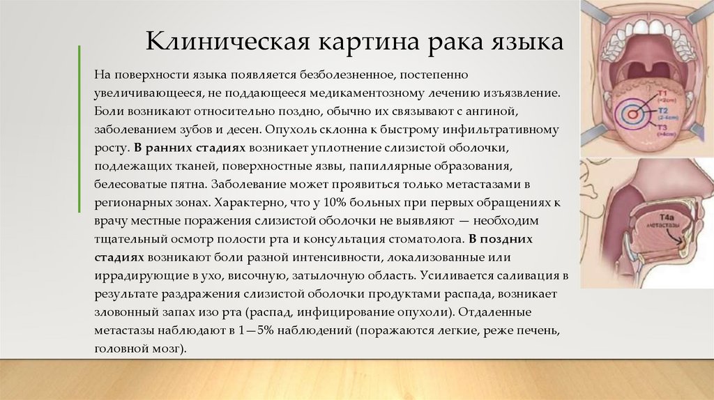 Клиническая картина рака языка