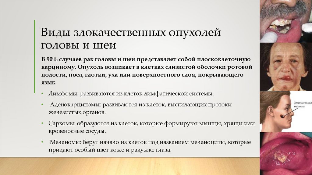 Виды злокачественных опухолей головы и шеи