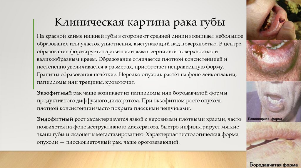 Клиническая картина рака губы