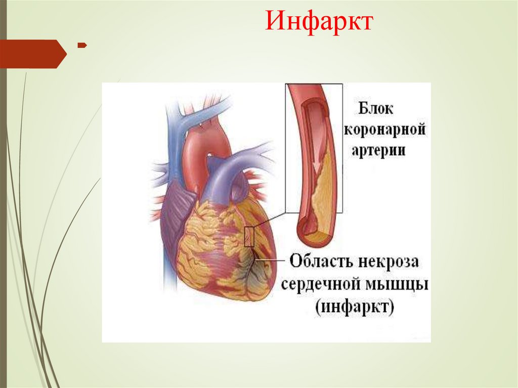 Инфаркт