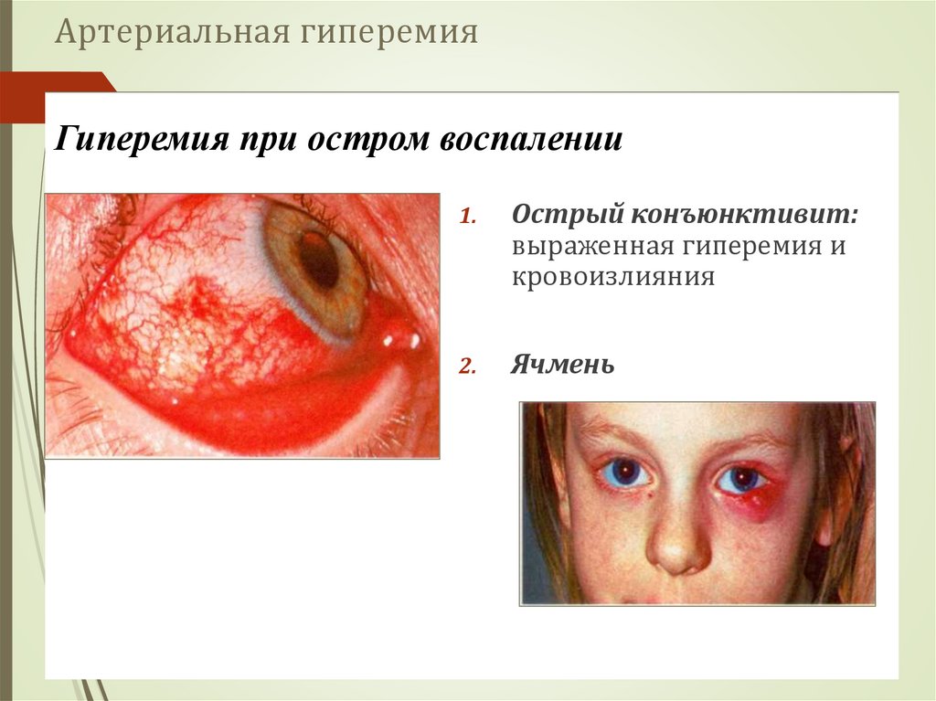 Артериальная гиперемия
