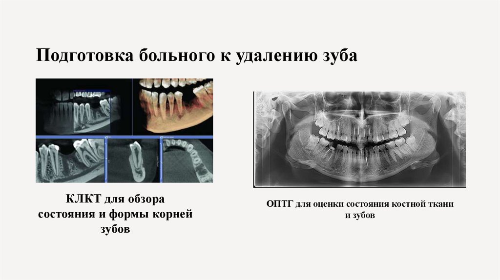 Подготовка больного к удалению зуба