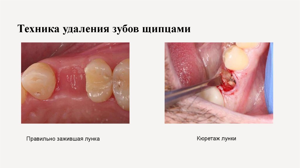 Техника удаления зубов щипцами