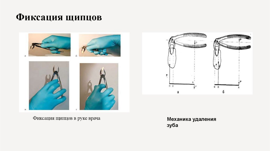 Фиксация щипцов