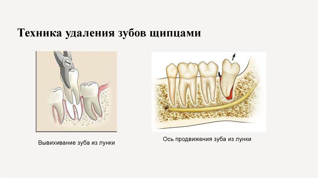 Техника удаления зубов щипцами