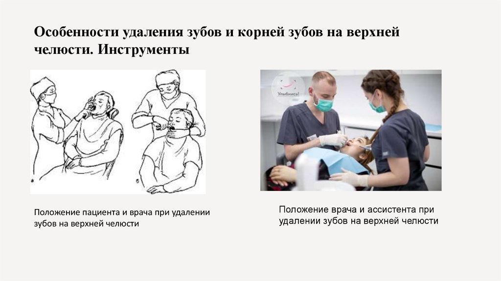 Особенности удаления зубов и корней зубов на верхней челюсти. Инструменты