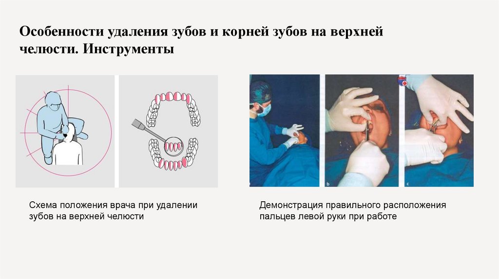 Особенности удаления зубов и корней зубов на верхней челюсти. Инструменты