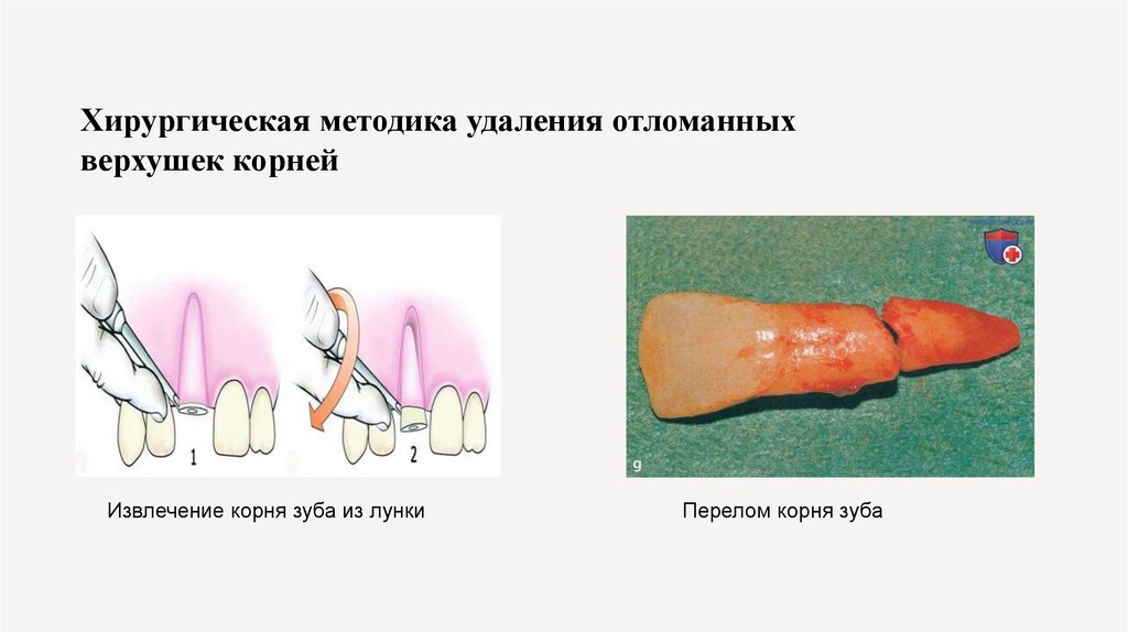 Хирургическая методика удаления отломанных верхушек корней