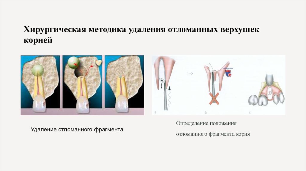 Хирургическая методика удаления отломанных верхушек корней
