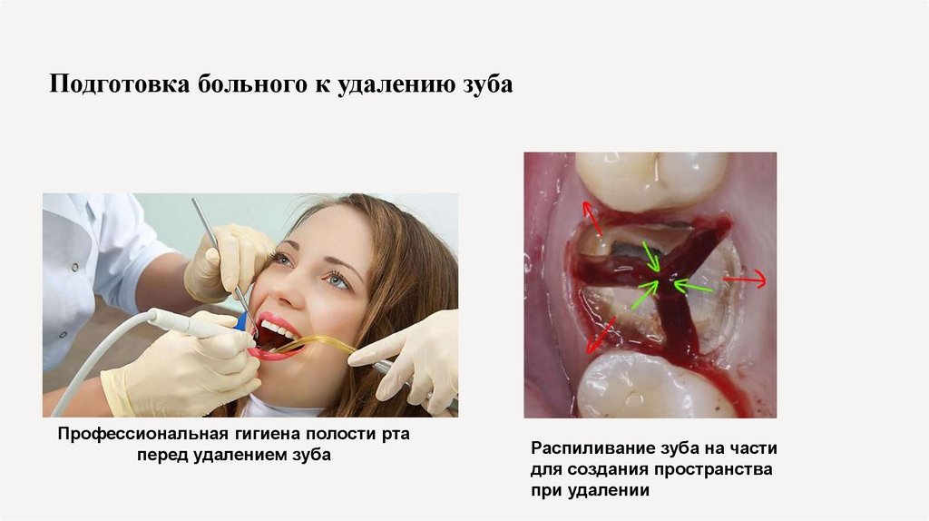 Подготовка больного к удалению зуба