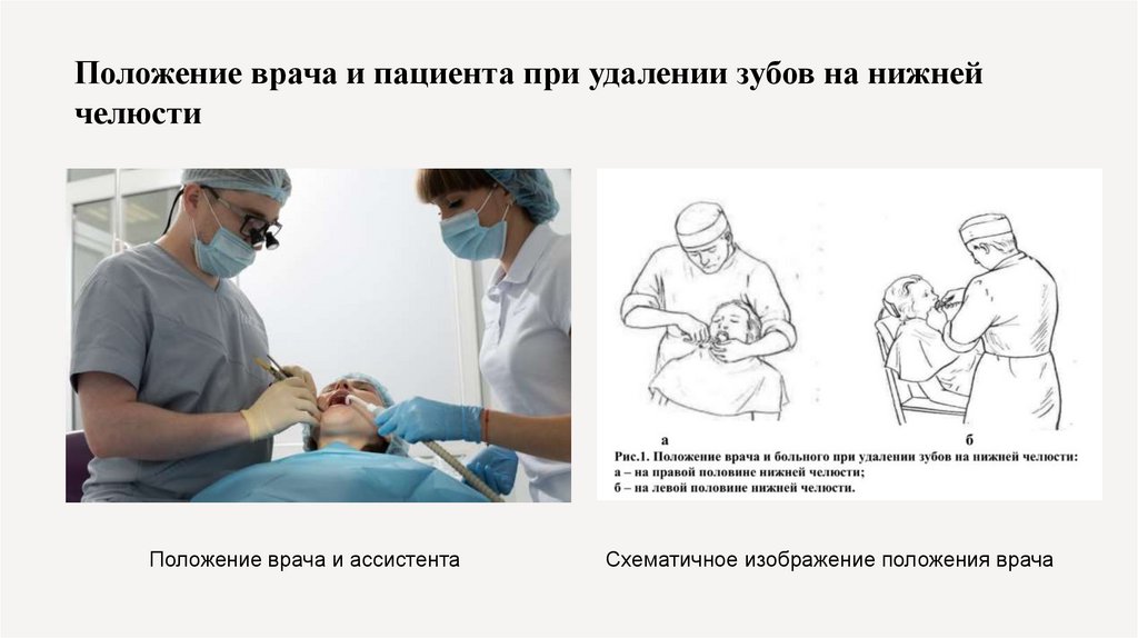 Положение врача и пациента при удалении зубов на нижней челюсти