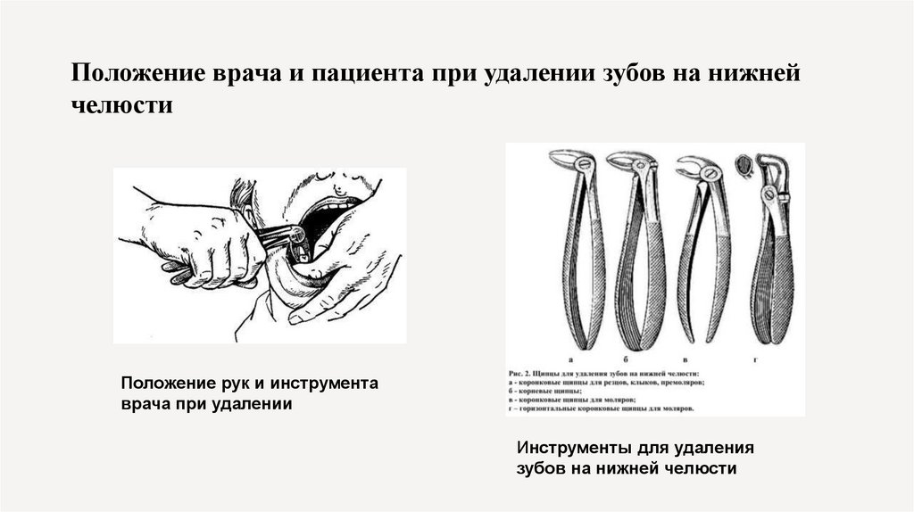 Положение врача и пациента при удалении зубов на нижней челюсти