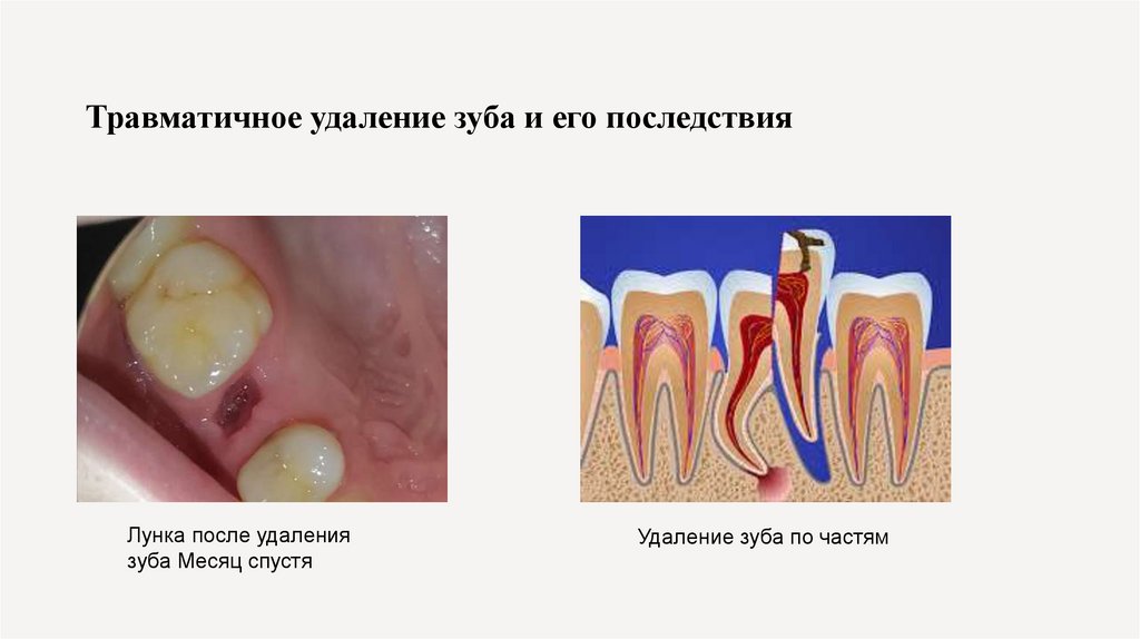 Травматичное удаление зуба и его последствия