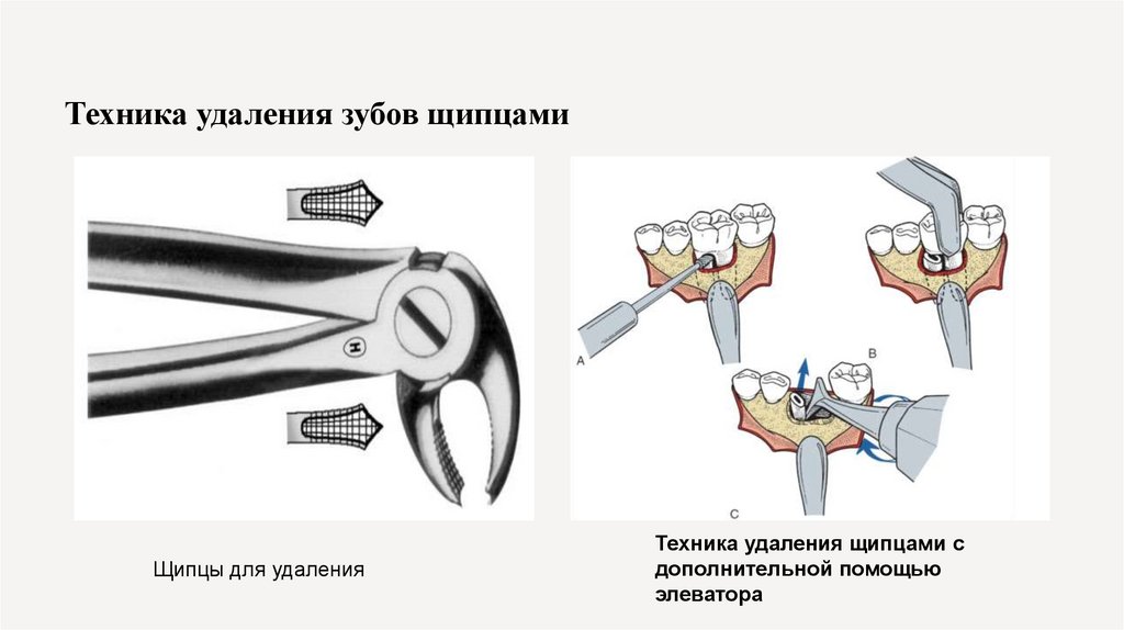 Техника удаления зубов щипцами