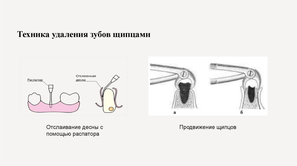 Техника удаления зубов щипцами