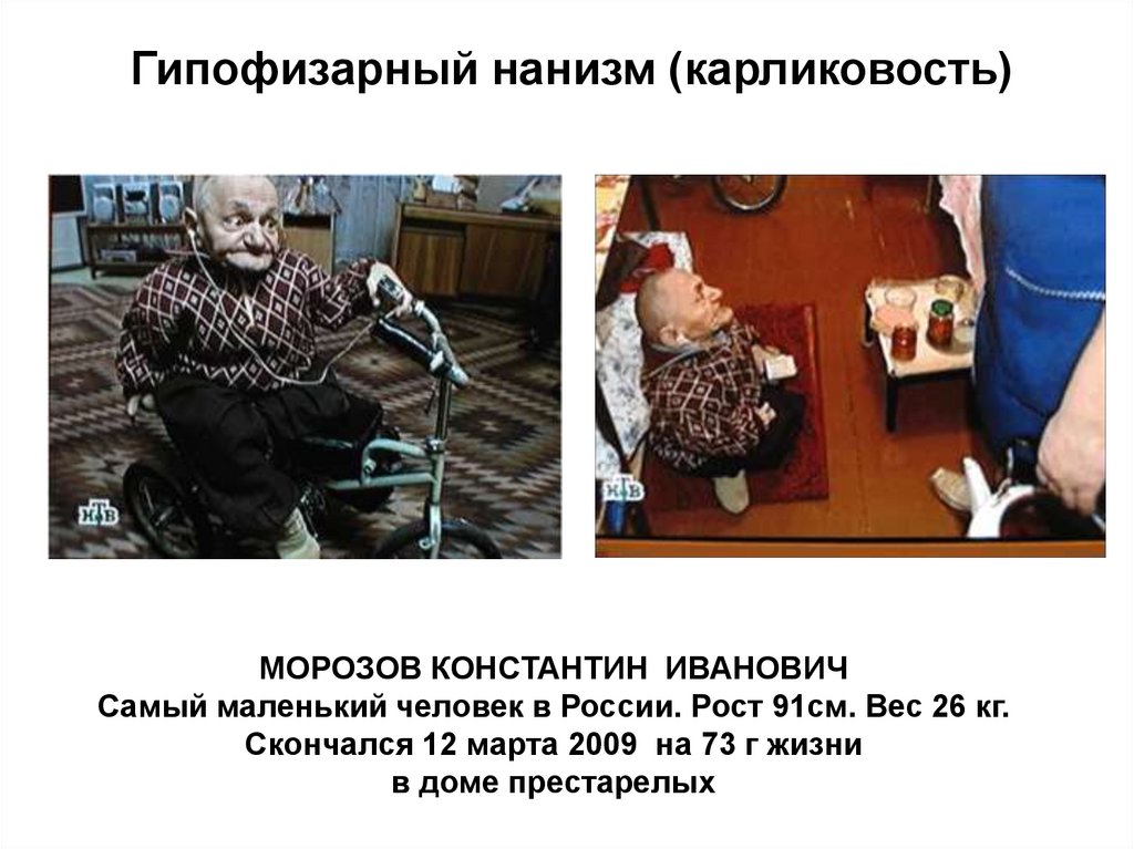 Гипофизарный нанизм (карликовость)