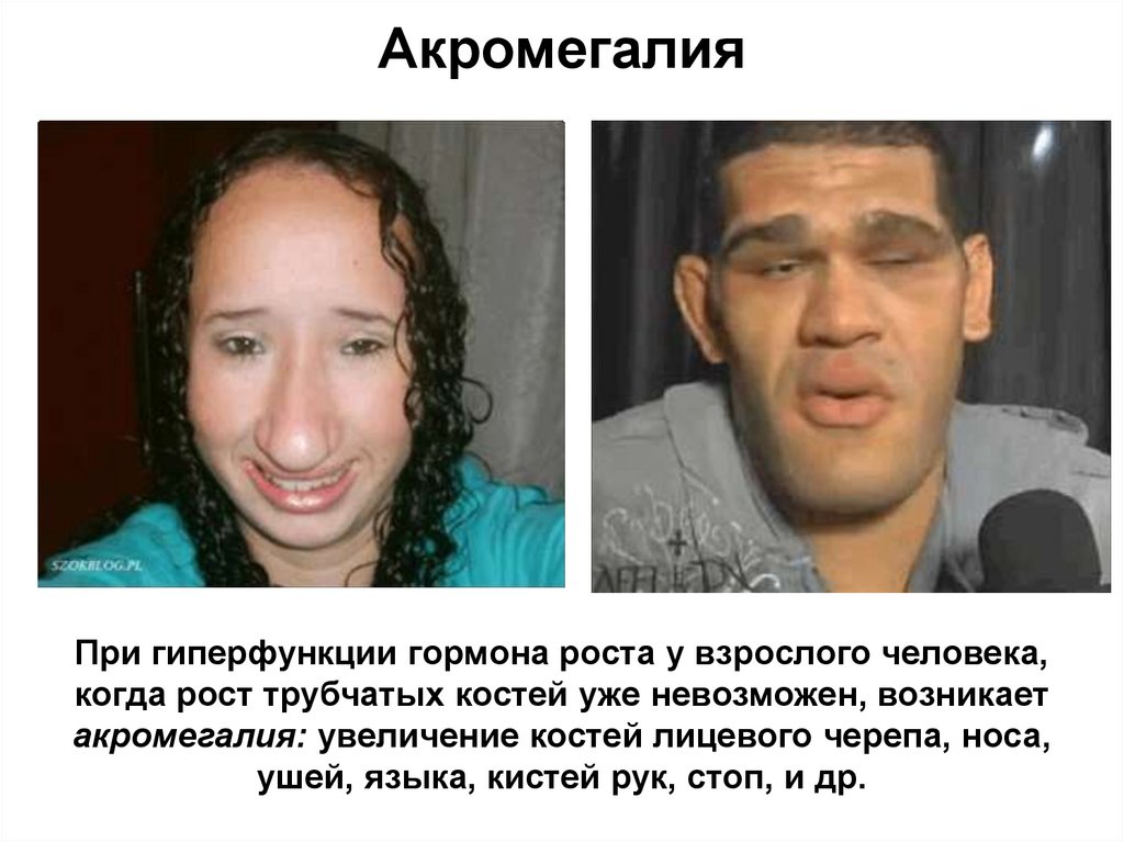 Акромегалия