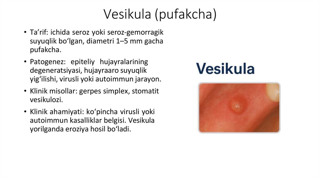 Vesikula (pufakcha)