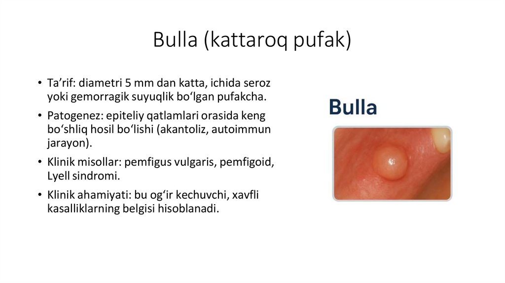 Bulla (kattaroq pufak)