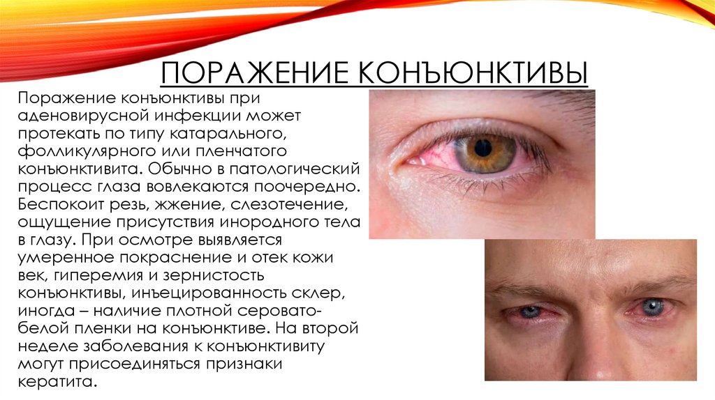 Поражение конъюнктивы