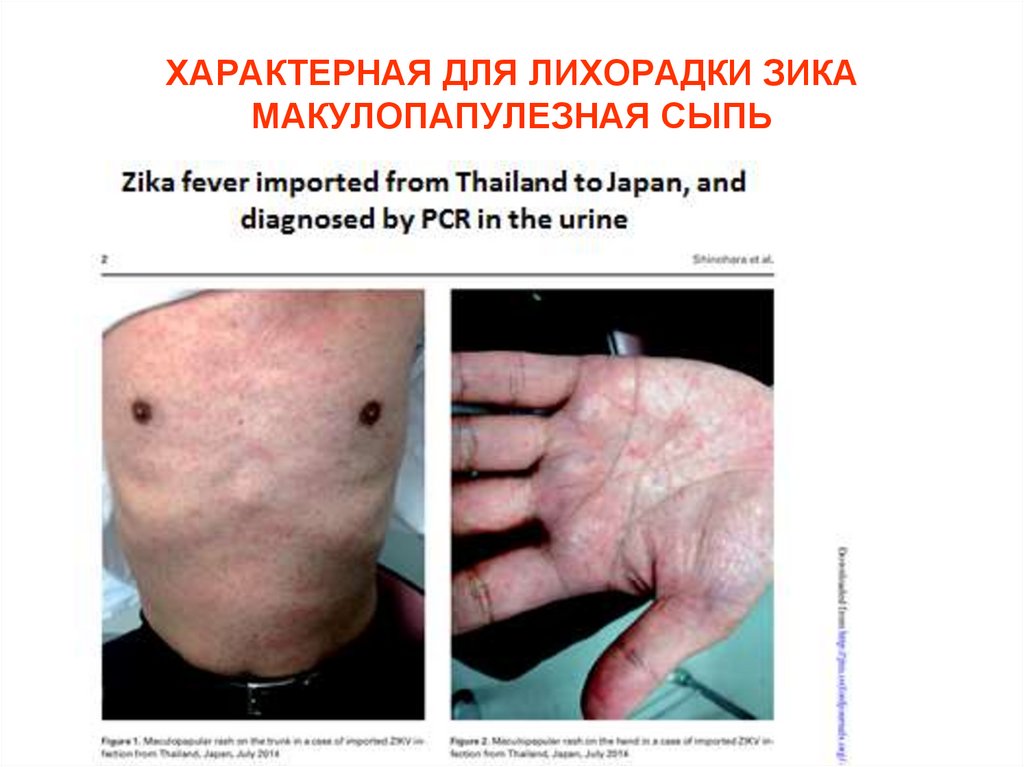 ХАРАКТЕРНАЯ ДЛЯ ЛИХОРАДКИ ЗИКА МАКУЛОПАПУЛЕЗНАЯ СЫПЬ