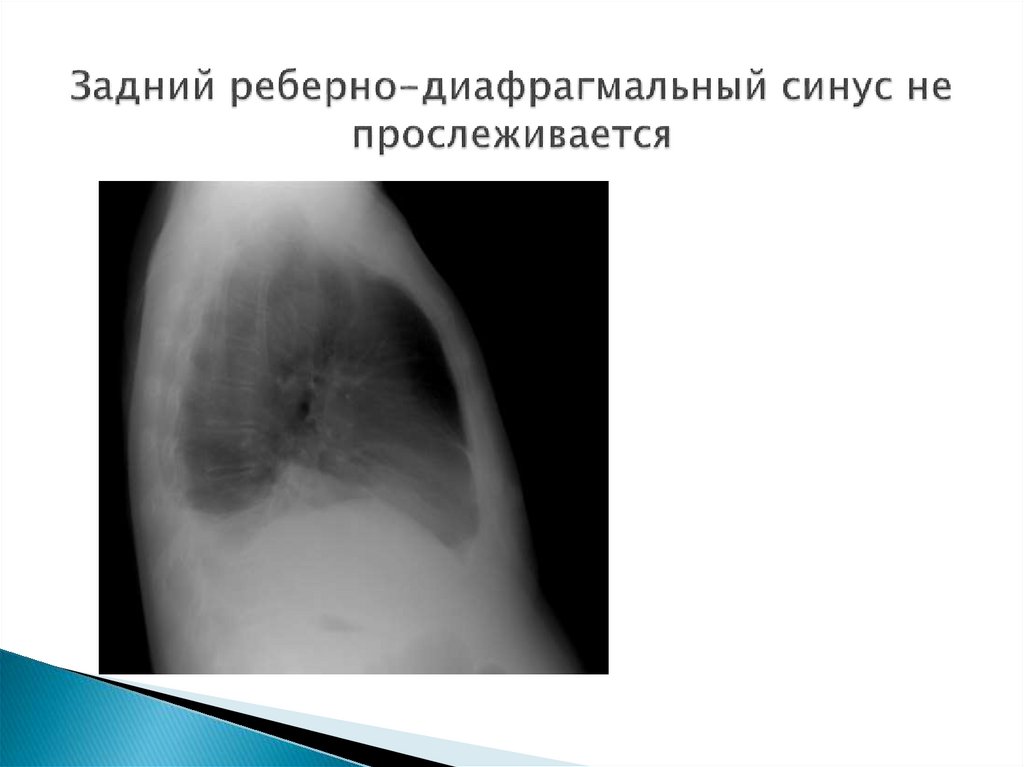 Задний реберно-диафрагмальный синус не прослеживается