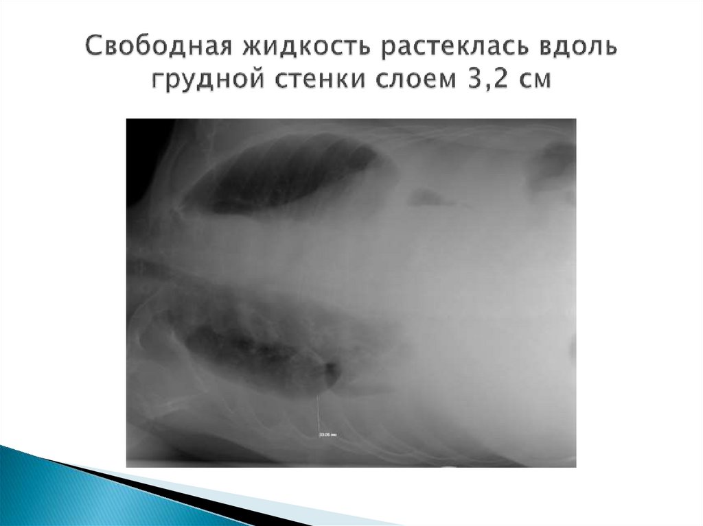 Свободная жидкость растеклась вдоль грудной стенки слоем 3,2 см
