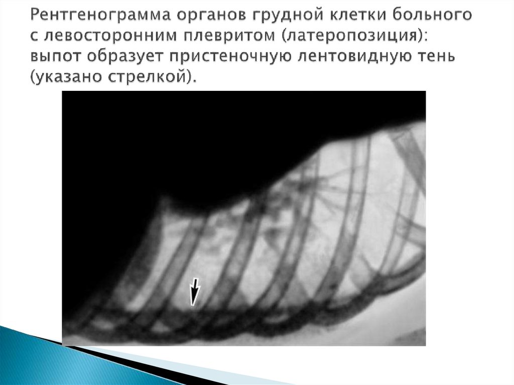 Рентгенограмма органов грудной клетки больного с левосторонним плевритом (латеропозиция): выпот образует пристеночную