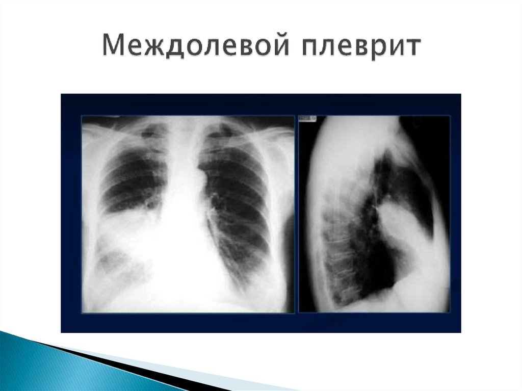 Междолевой плеврит