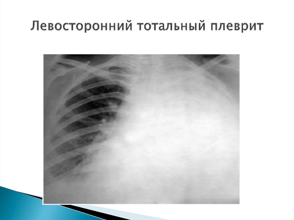 Левосторонний тотальный плеврит
