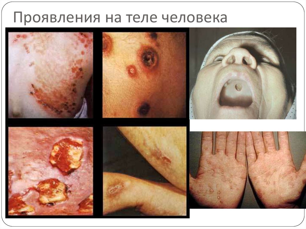 Проявления на теле человека