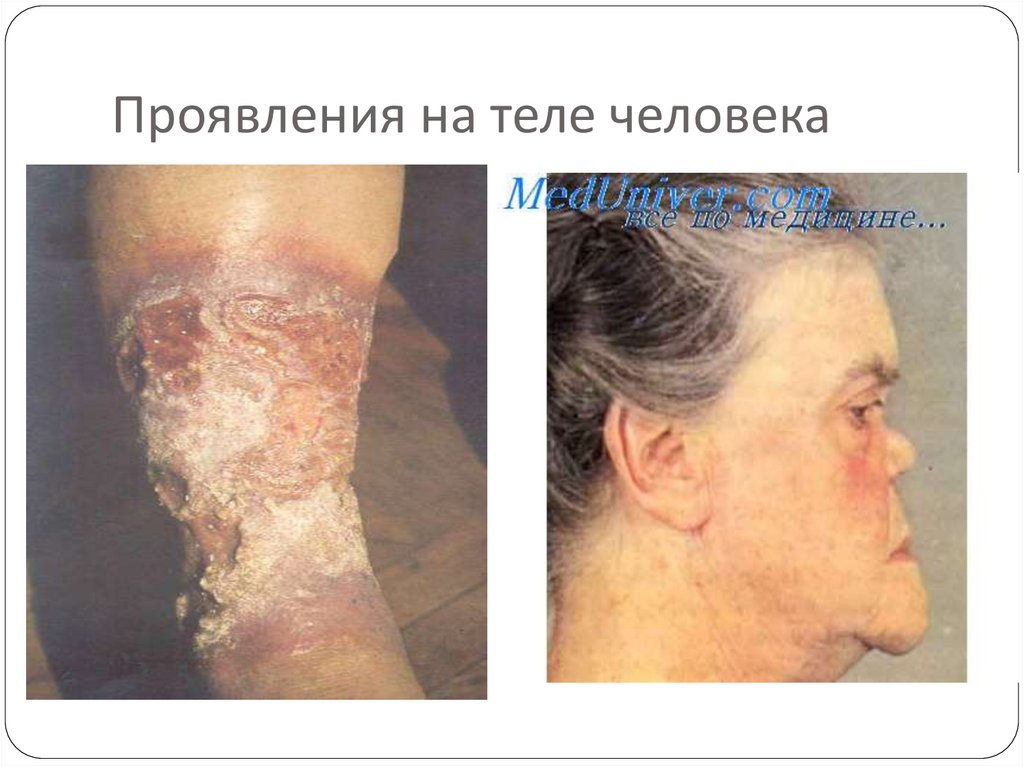 Проявления на теле человека