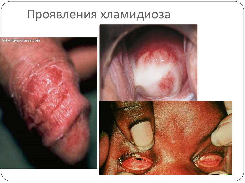 Проявления хламидиоза