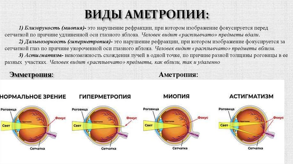 ВИДЫ АМЕТРОПИИ: