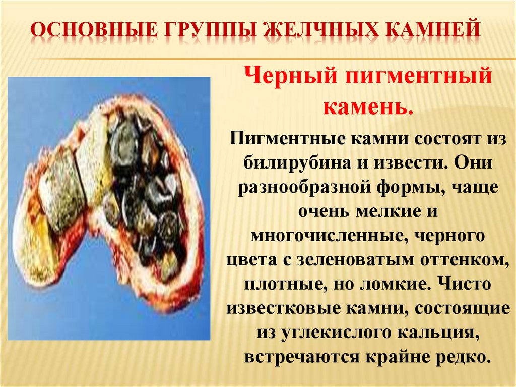 Основные группы желчных камней