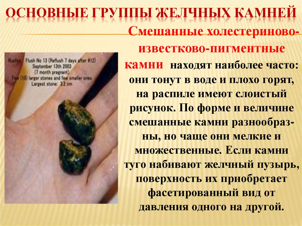 Основные группы желчных камней