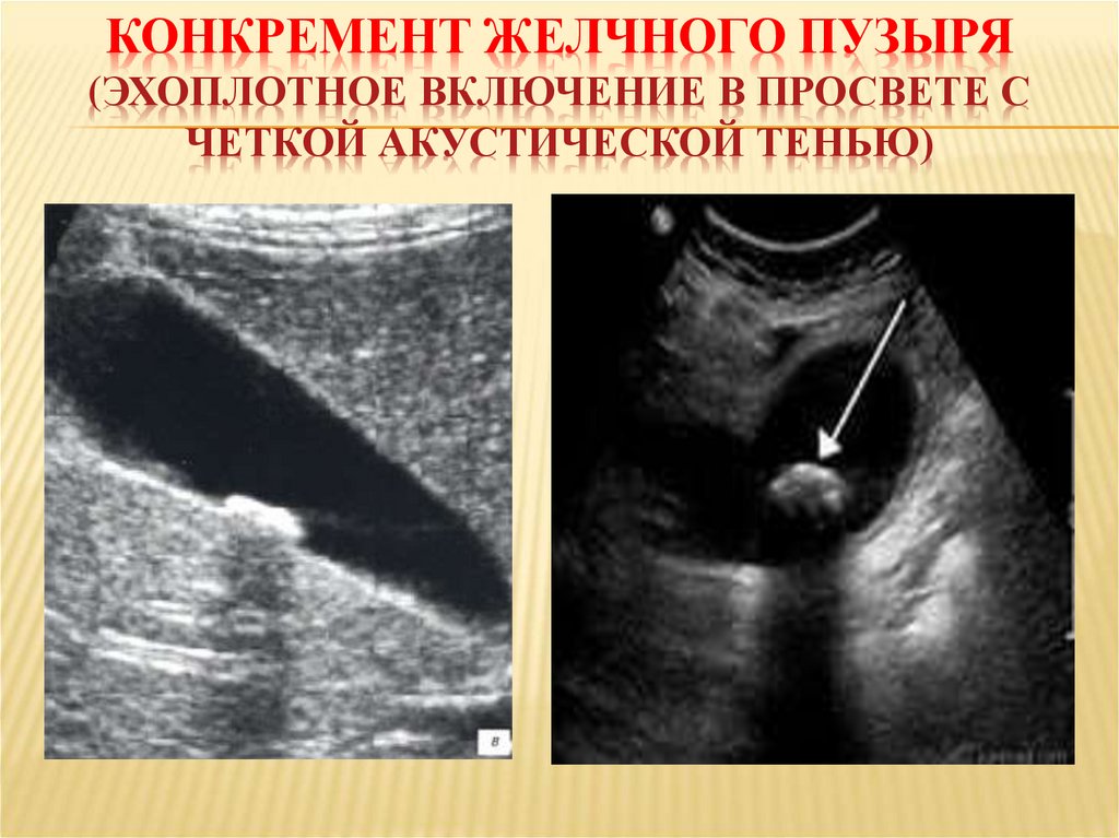 Конкремент желчного пузыря (эхоплотное включение в просвете с четкой акустической тенью)