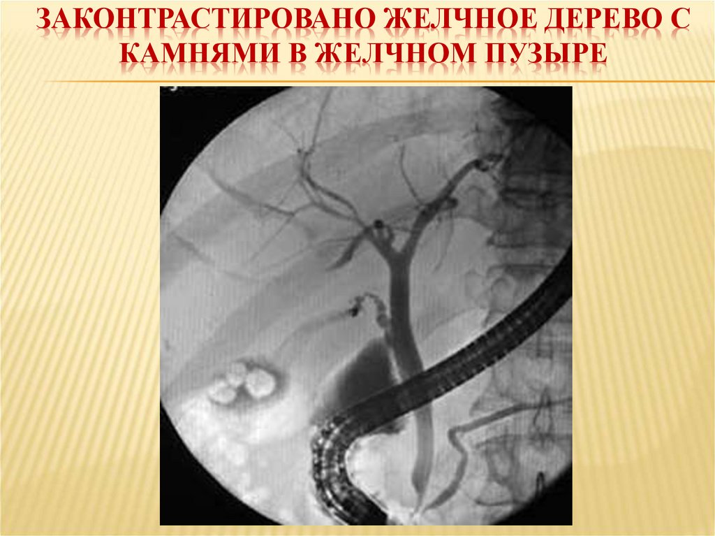 Законтрастировано желчное дерево с камнями в желчном пузыре