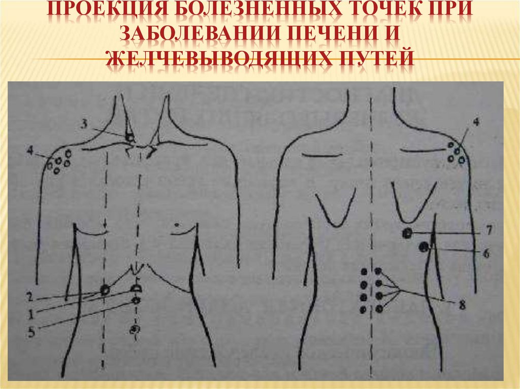 Проекция болезненных точек при заболевании печени и желчевыводящих путей