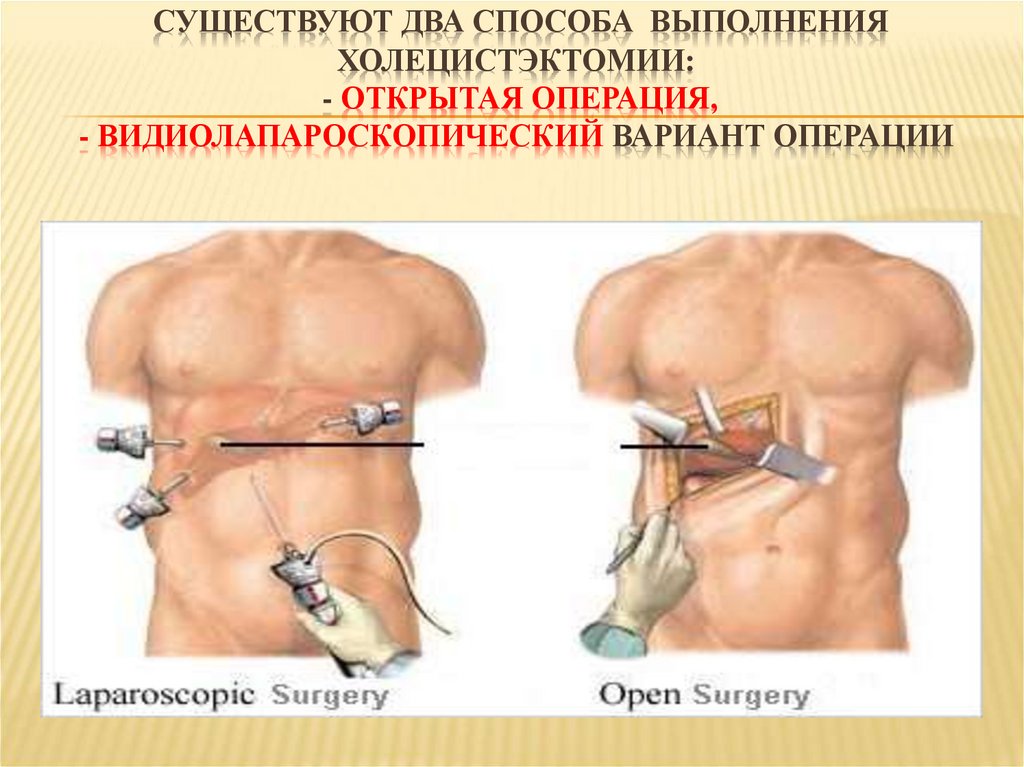 Существуют два способа выполнения холецистэктомии: - открытая операция, - видиолапароскопический вариант операции