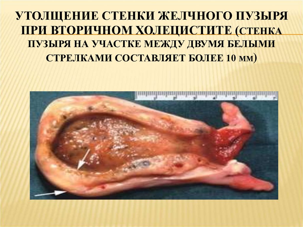 Утолщение стенки желчного пузыря при вторичном холецистите (стенка пузыря на участке между двумя белыми стрелками составляет