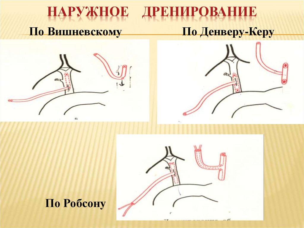 Наружное дренирование