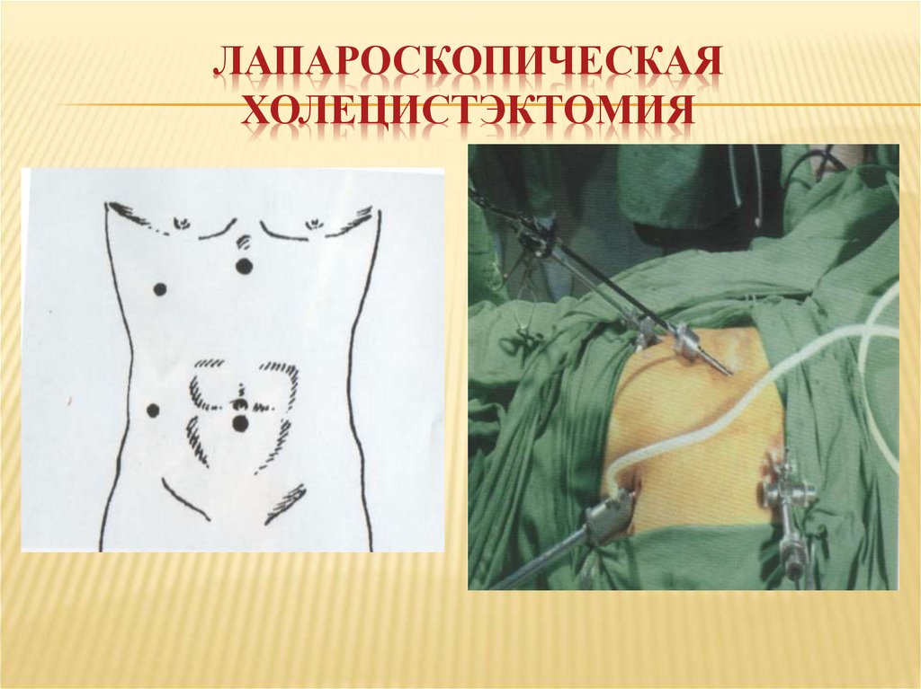 Лапароскопическая холецистэктомия