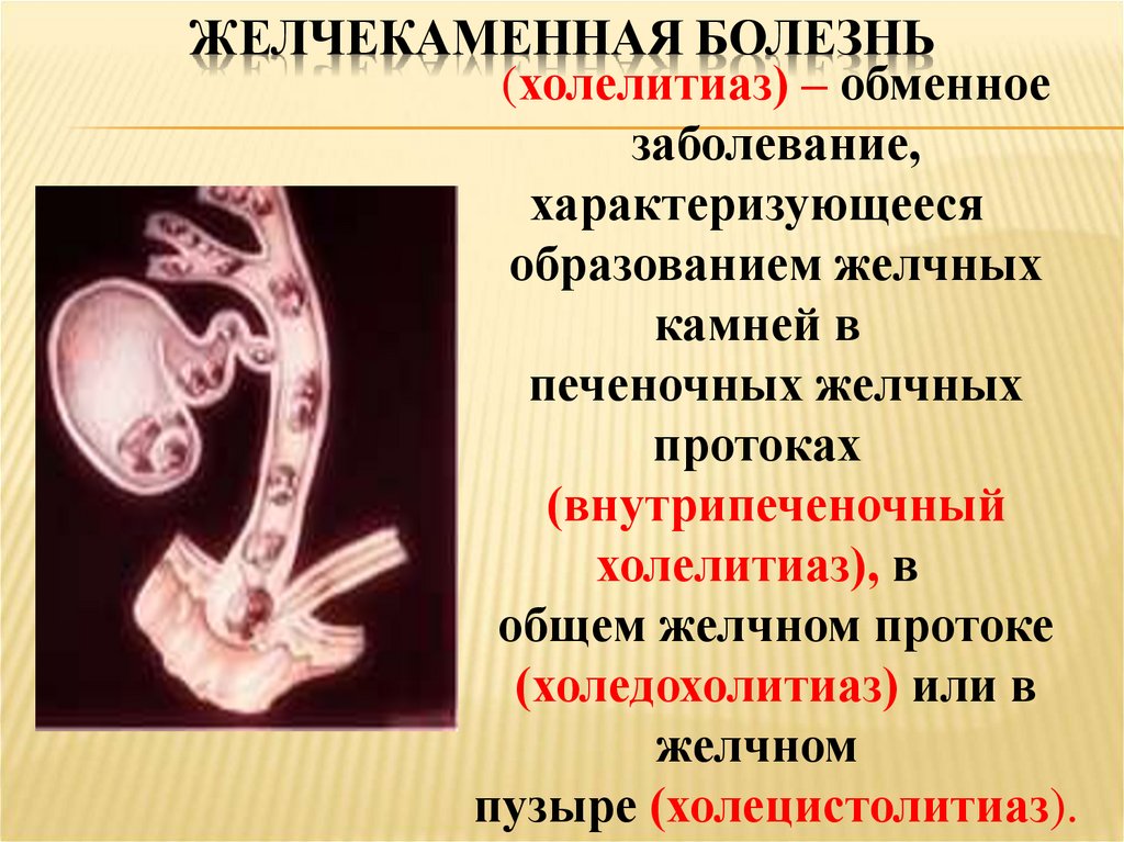 Желчекаменная болезнь