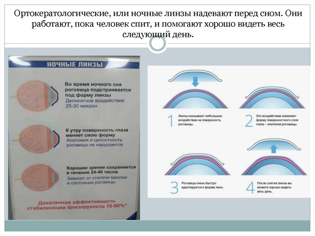 Ортокератологические, или ночные линзы надевают перед сном. Они работают, пока человек спит, и помогают хорошо видеть весь